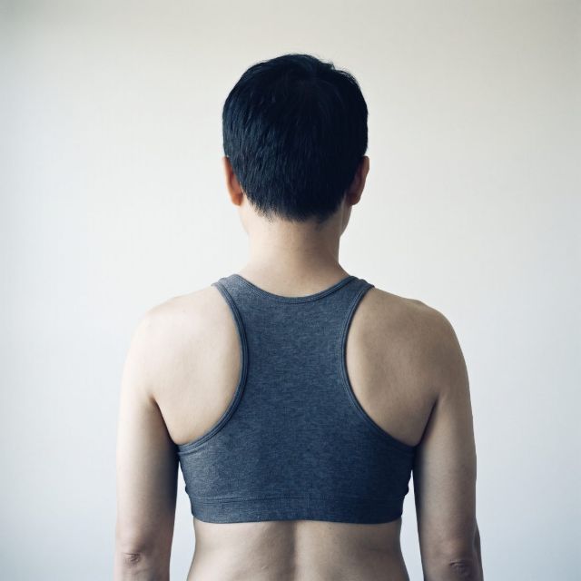 Scoliosis